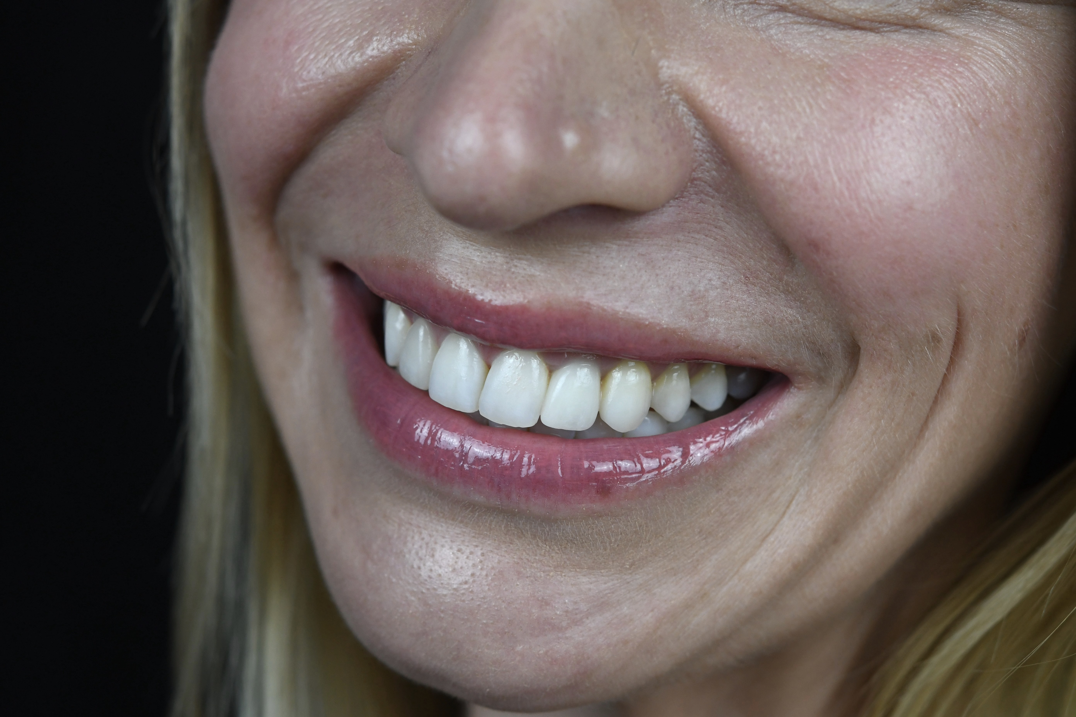 Fig. 14: Final smile close-up photograph.