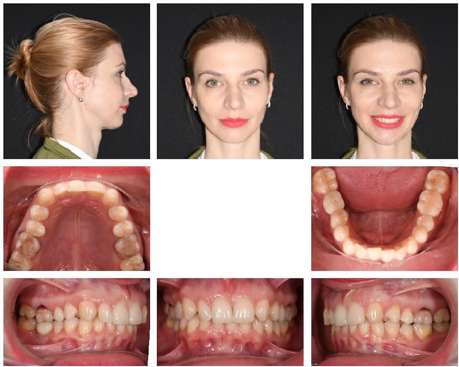 Dental News - Treatment of a patient with a congenitally missing ...