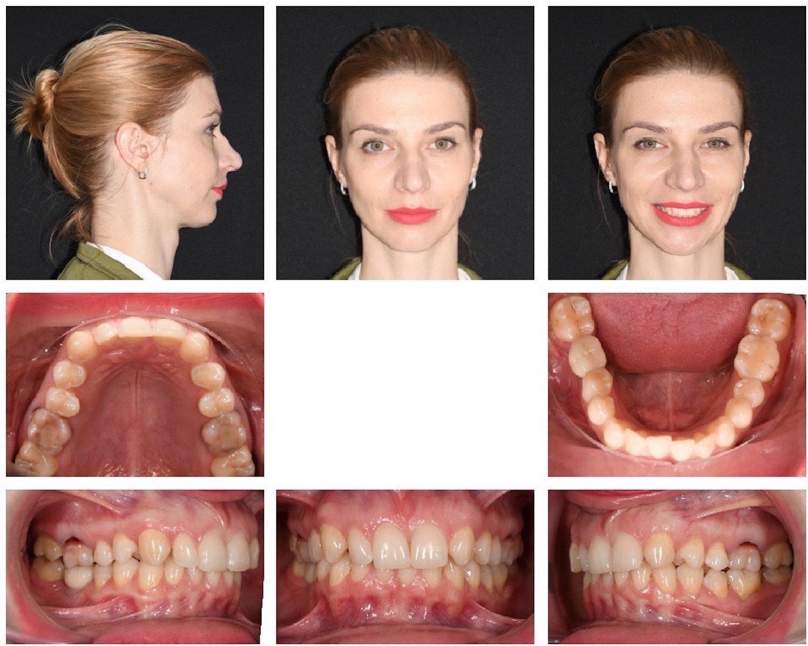 Fig. 1: Pretreatment facial and intra-oral photographs.