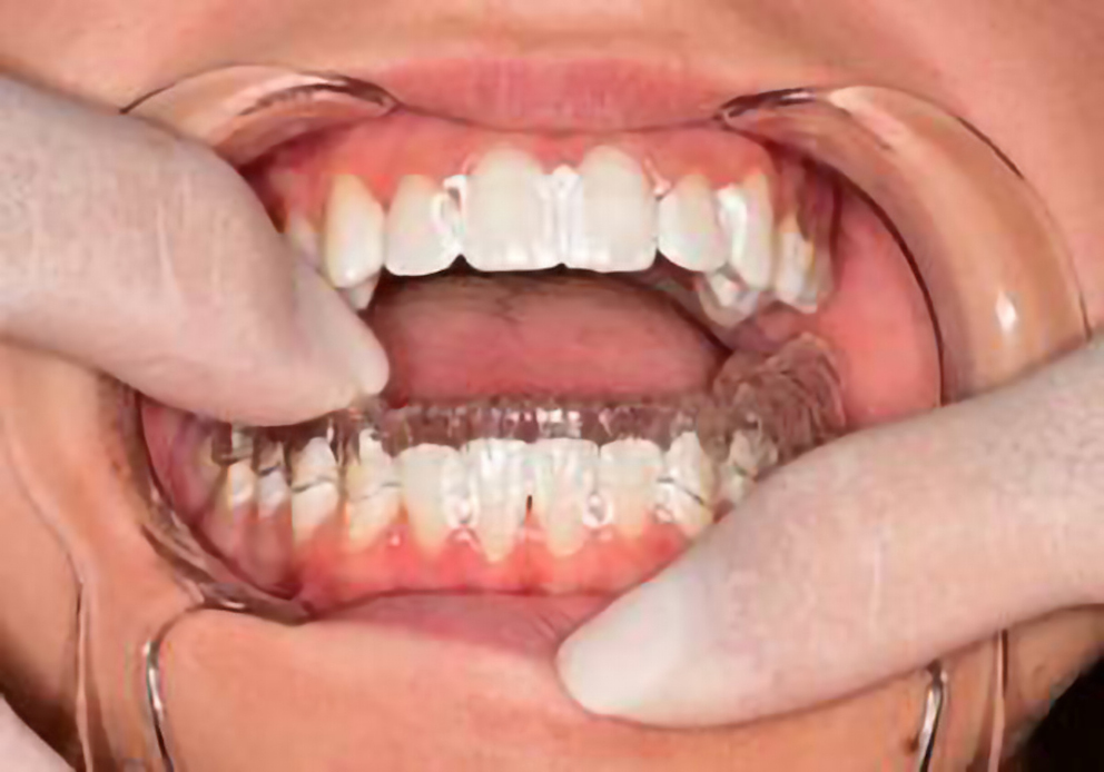 Fig. 15: The patient wearing the aligner after fluoride application.